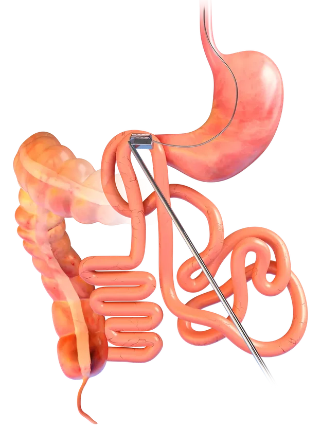 Two sections of the gut brought together by the magnets