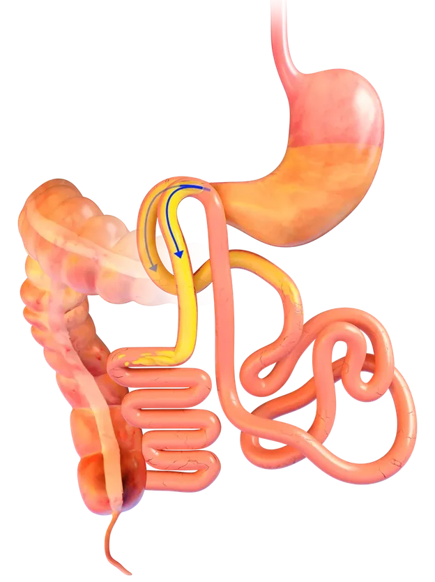 Some food follows the new shorter route through the gut
